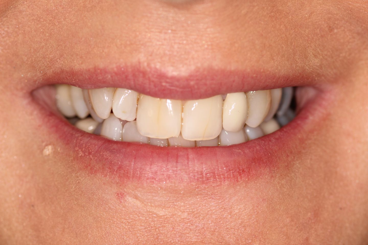 Fiona - Hygiene, Invisalign, white fillings, whitening and crowns