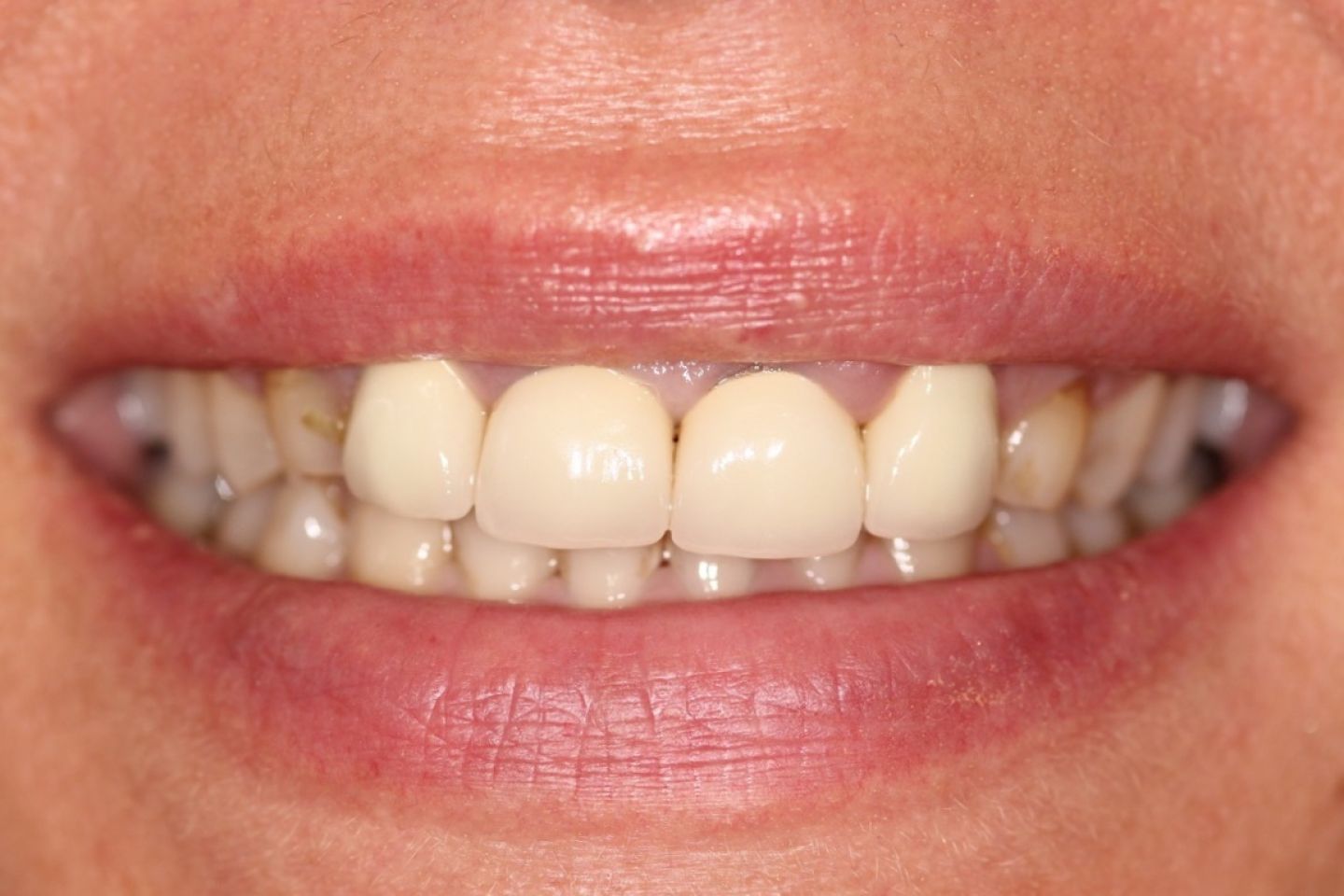 Lettitia - Veneers & Whitening