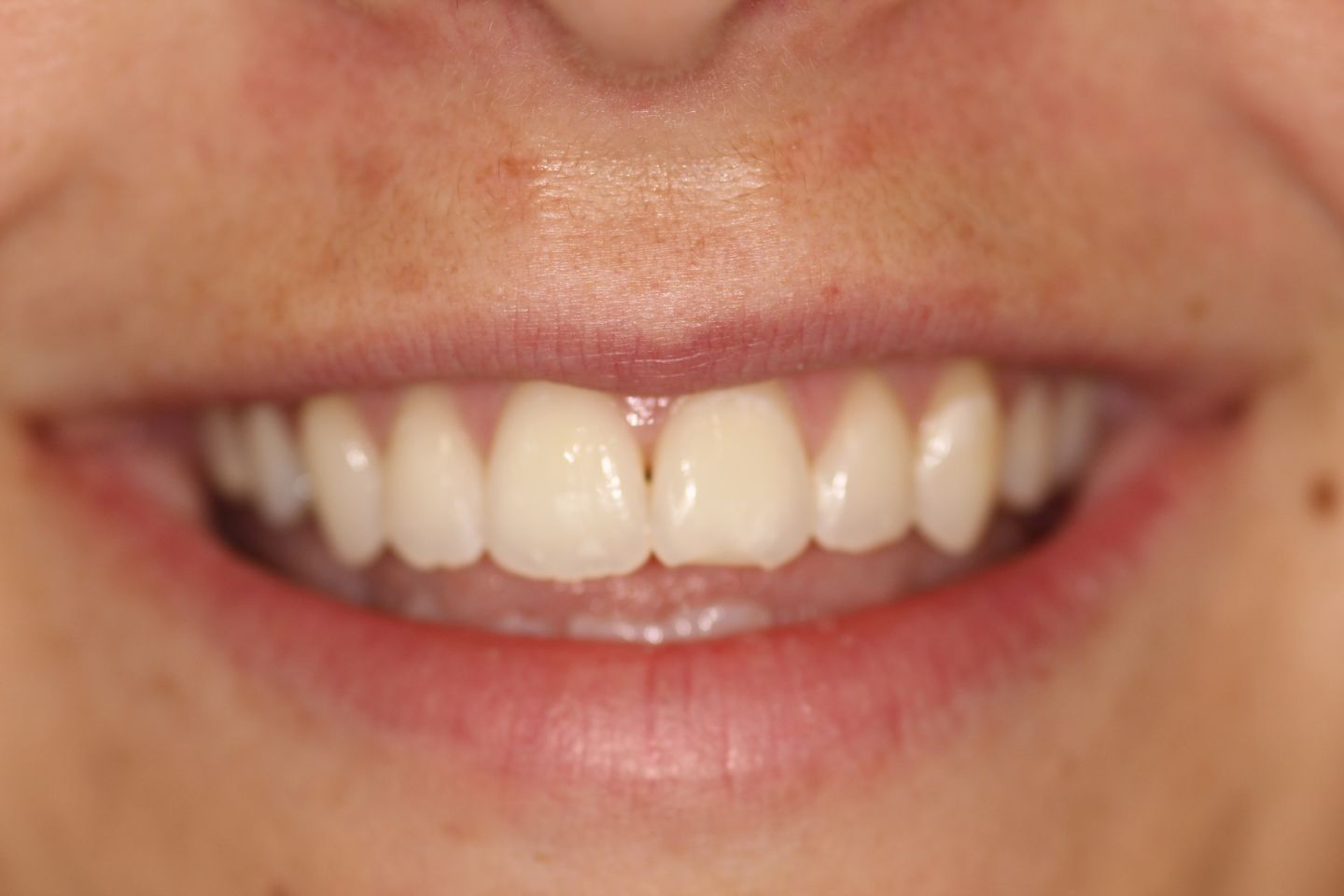 Harriet - Invisalign and whitening