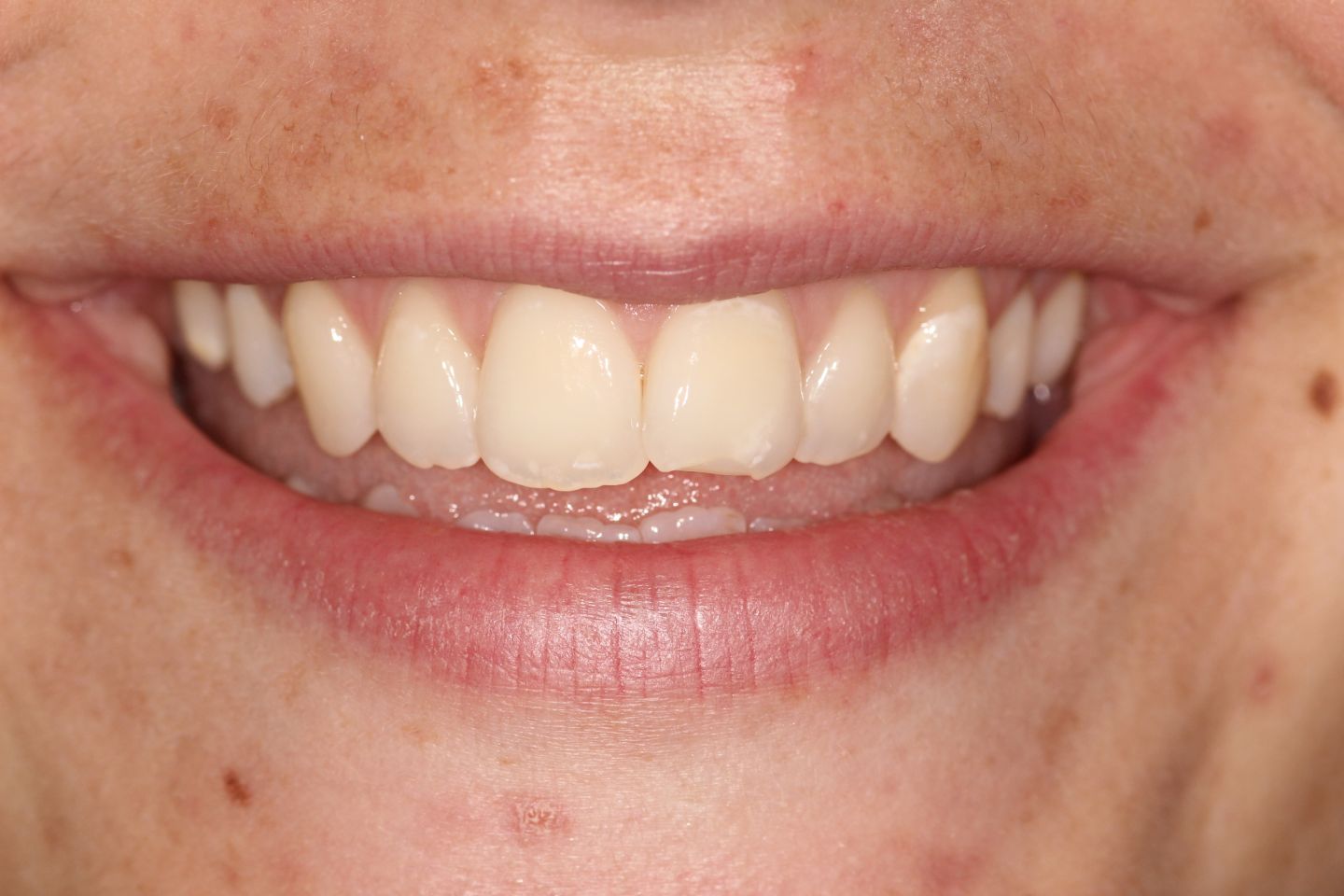 Harriet - Invisalign and whitening