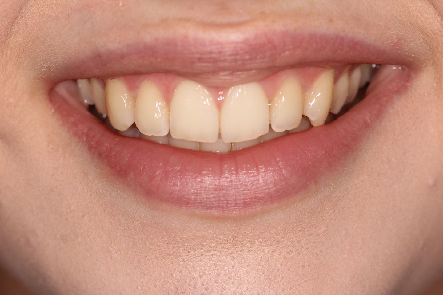 Emily - Invisalign and Whitening