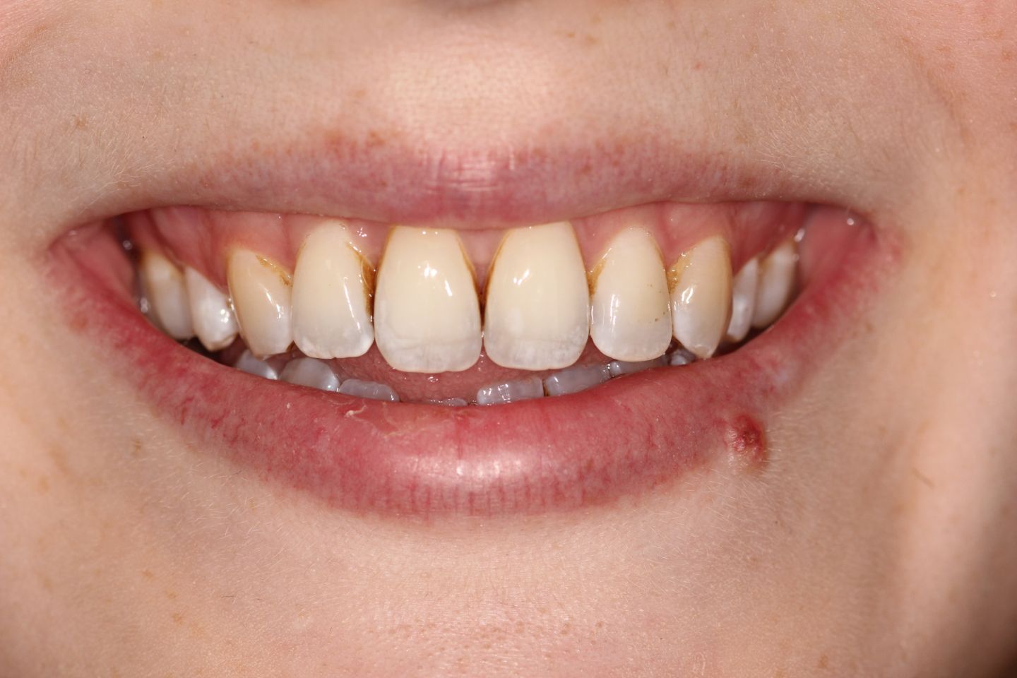 Laura - Hygiene, Invisalign and whitening