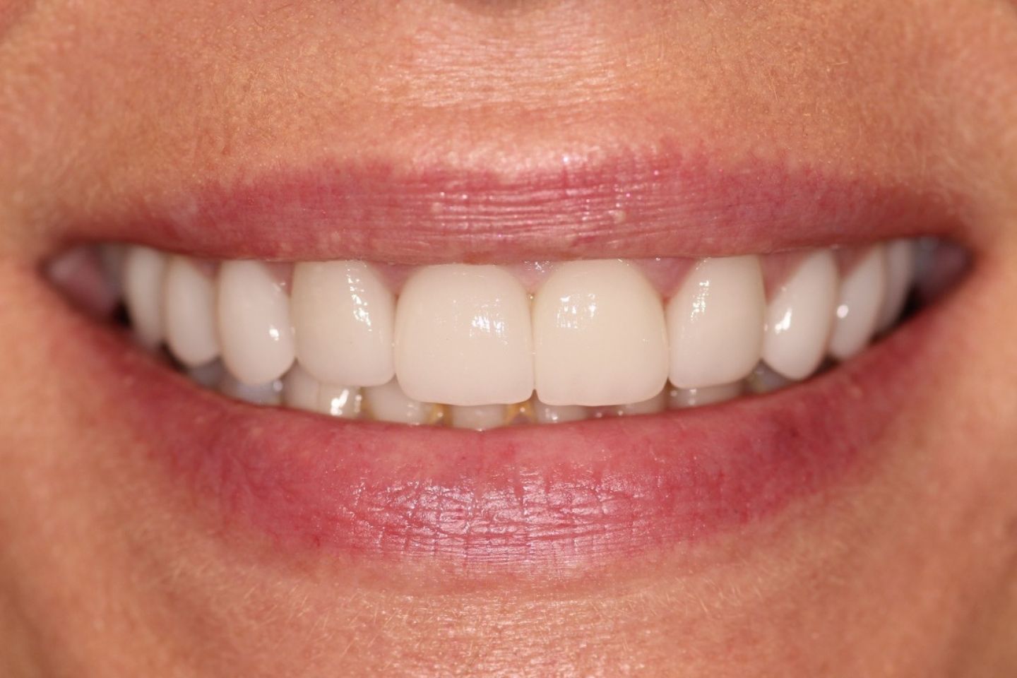 Lettitia - Veneers & Whitening