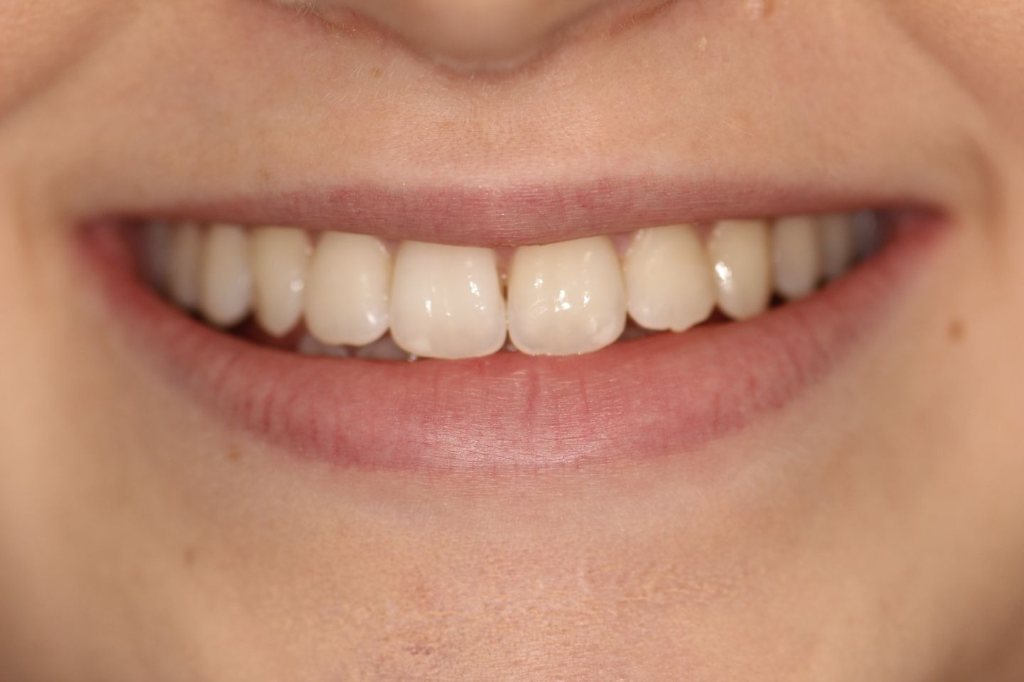 Kirsty - Invisalign and whitening