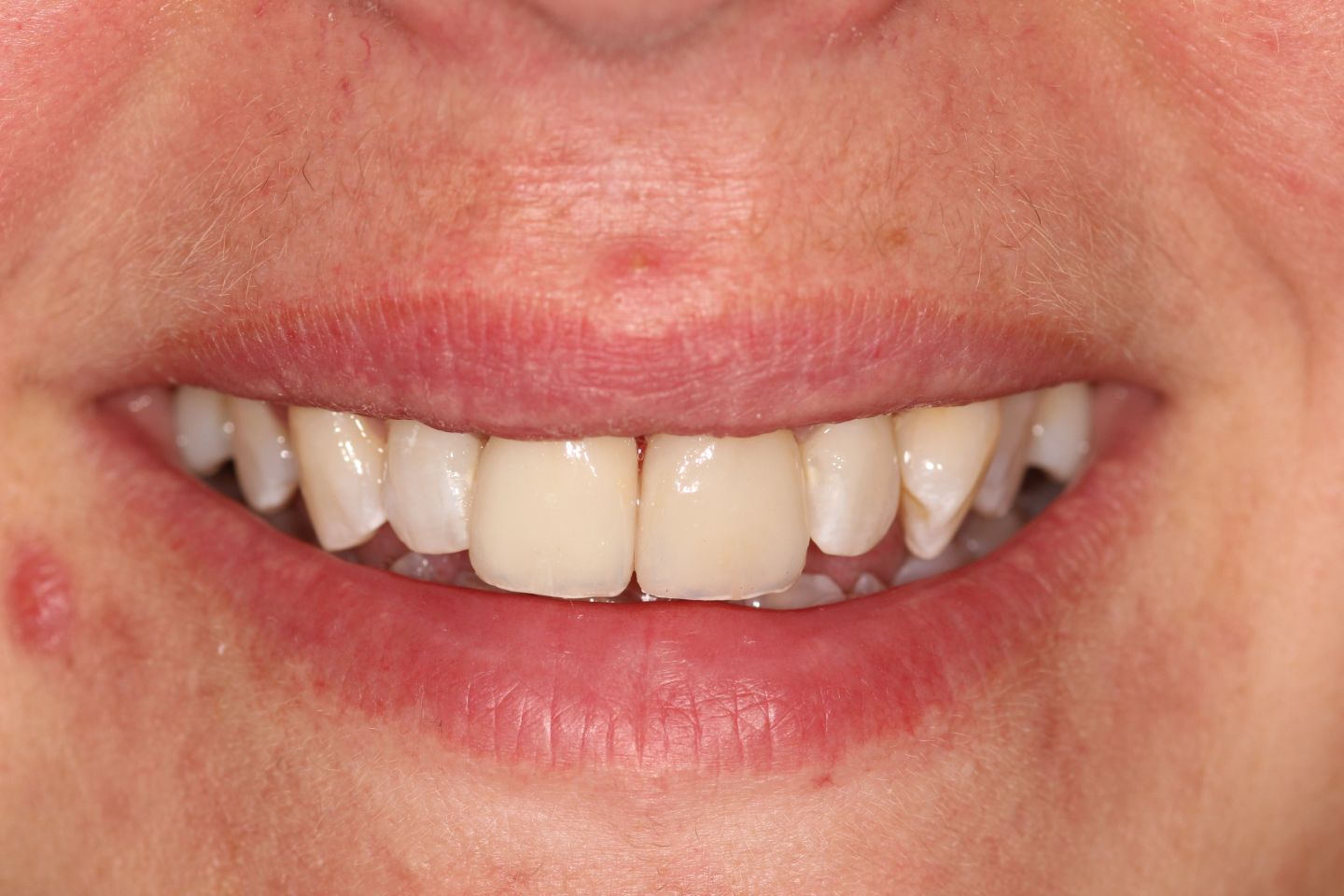 Bryony - Whitening and veneers