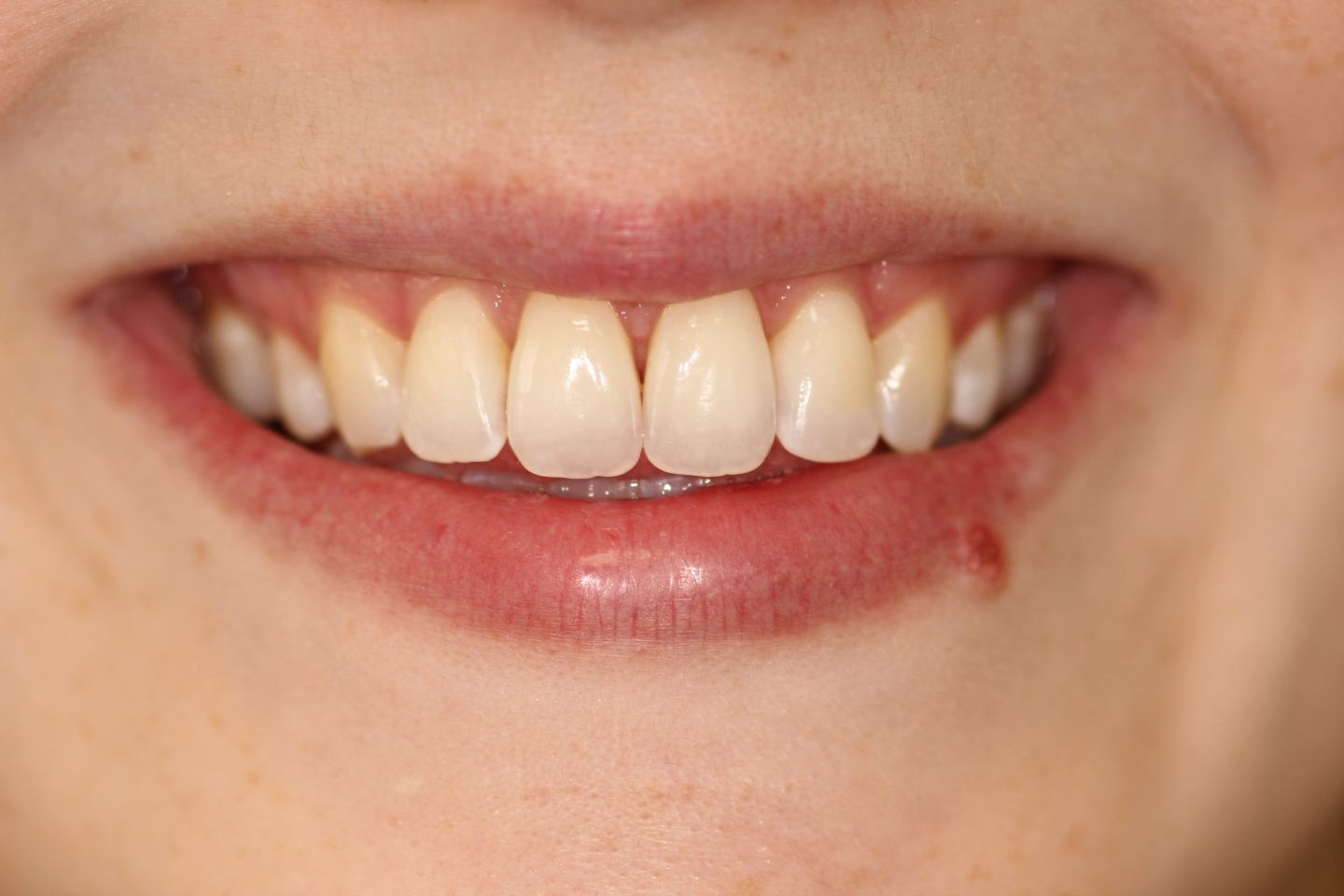 Laura - Hygiene, Invisalign and whitening