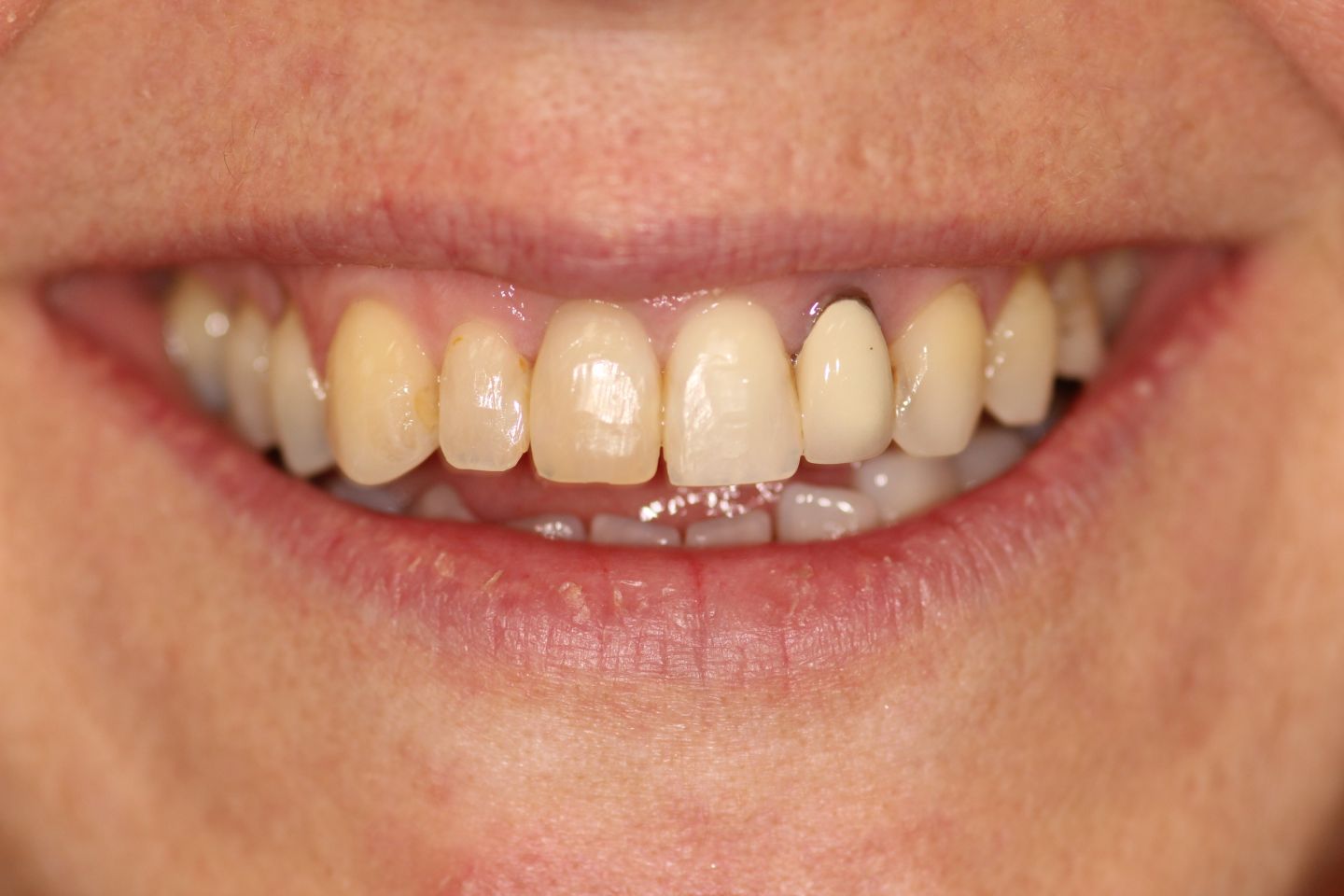 Alexa - Invisalign, white fillings and whitening