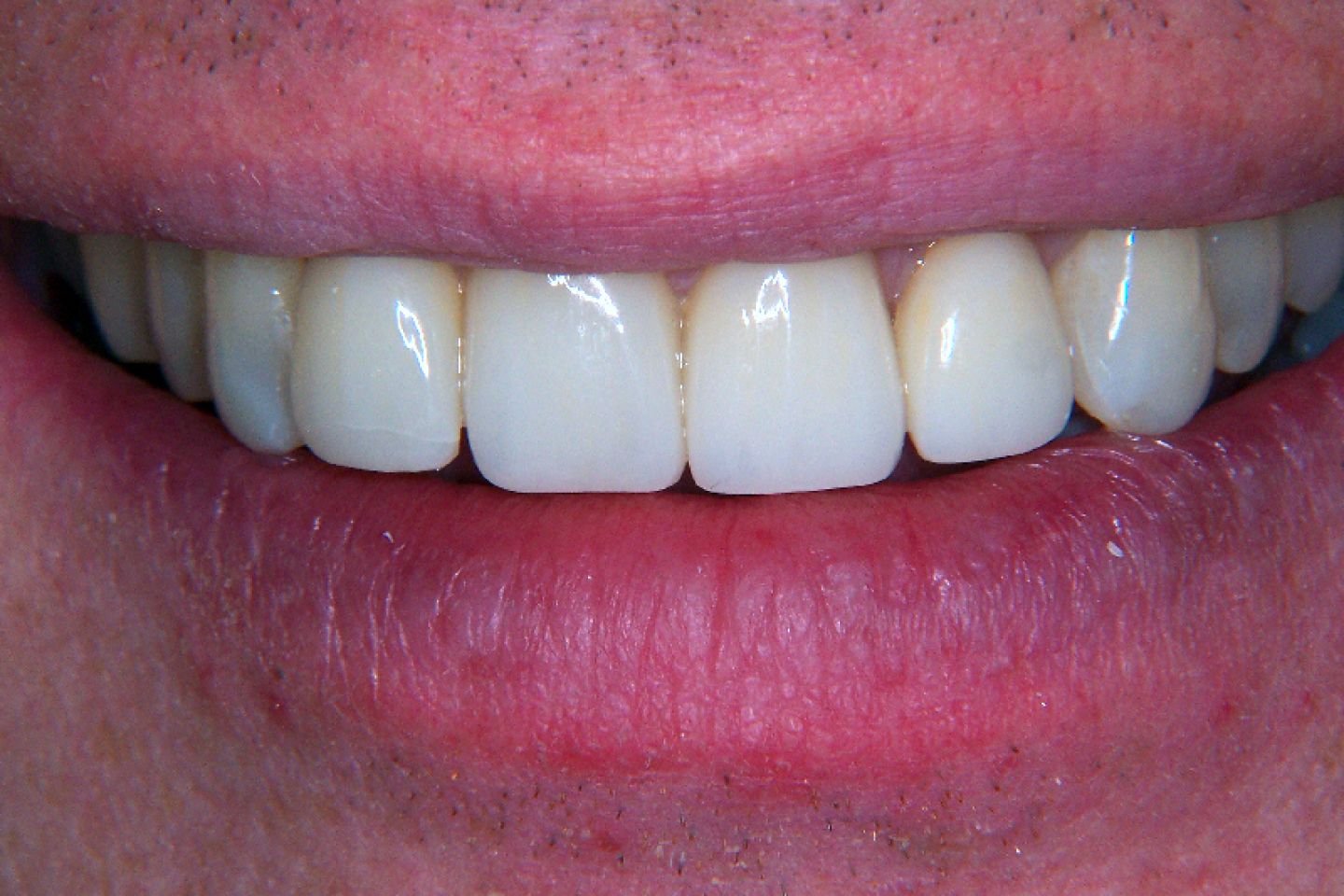 Cliff - Veneers and Whitening