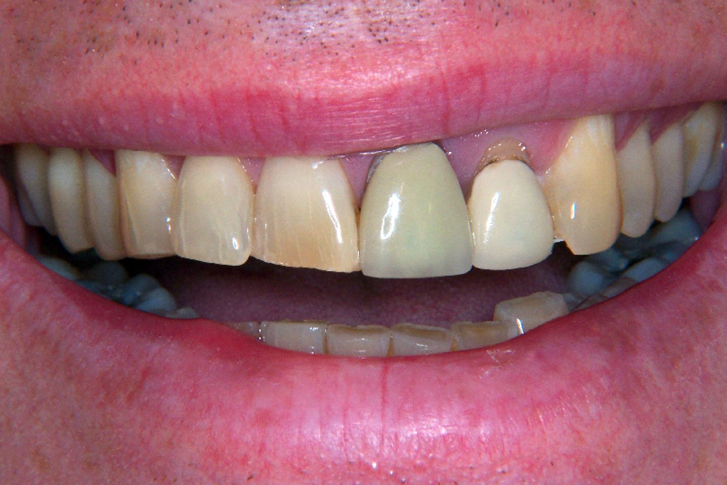 Cliff - Veneers and Whitening