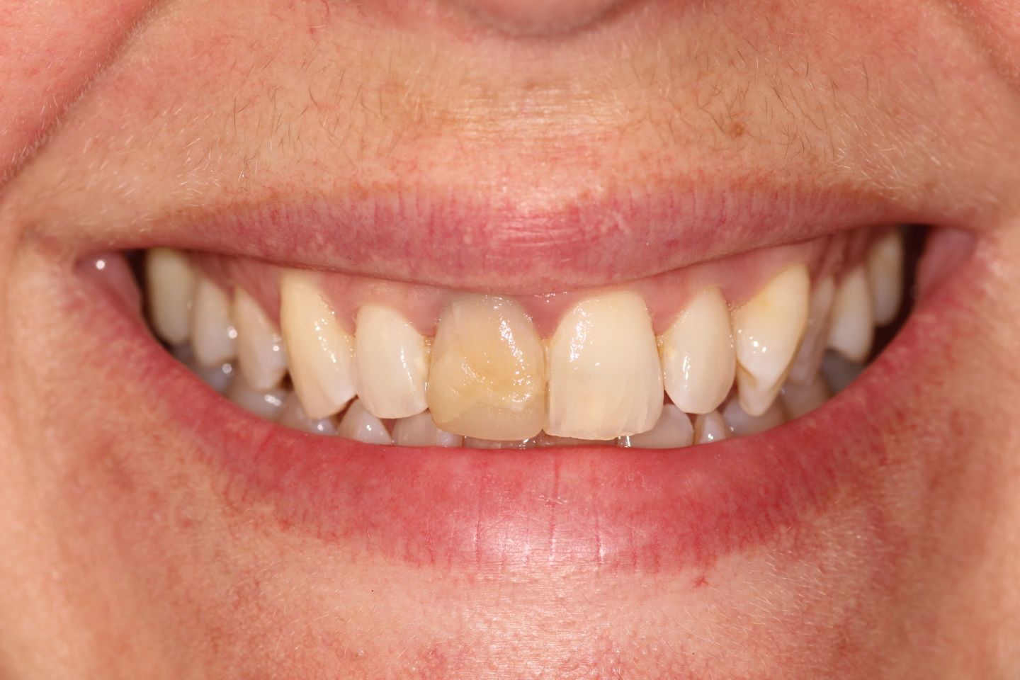 Bryony - Whitening and veneers