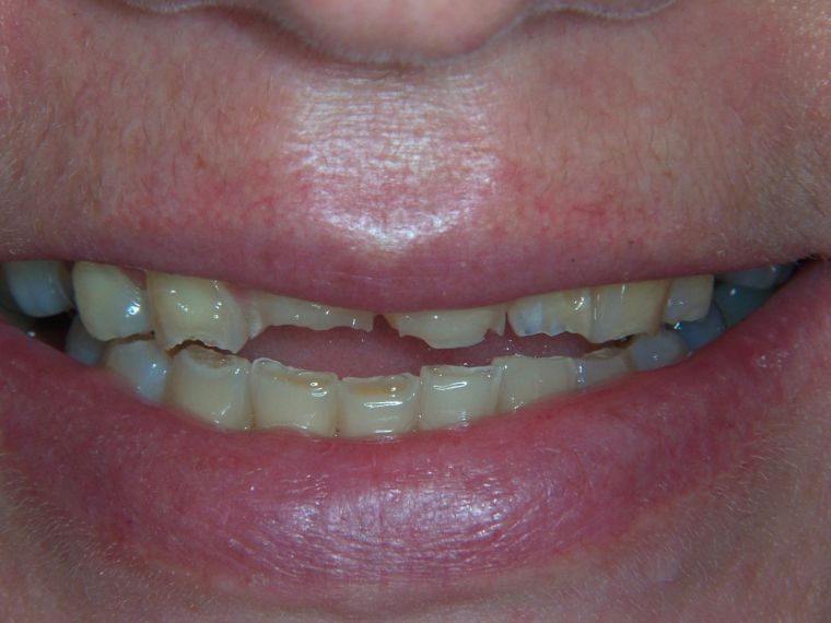 Veneers - Before