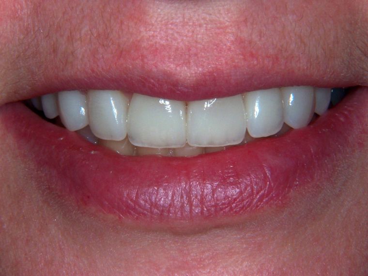 Veneers - After