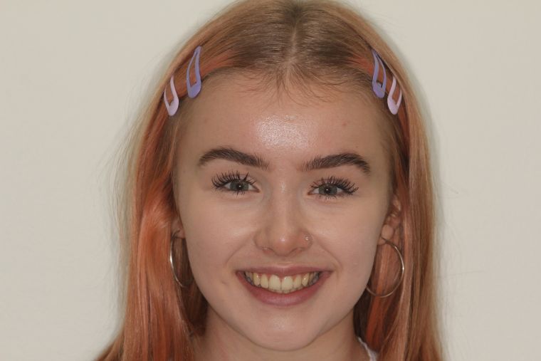 Portrait image of a girl smiling and showing her teeth whitening and straight teeth.