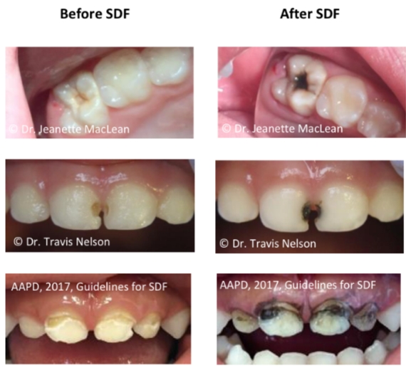 Before and after silver diamine fluoride treatment.